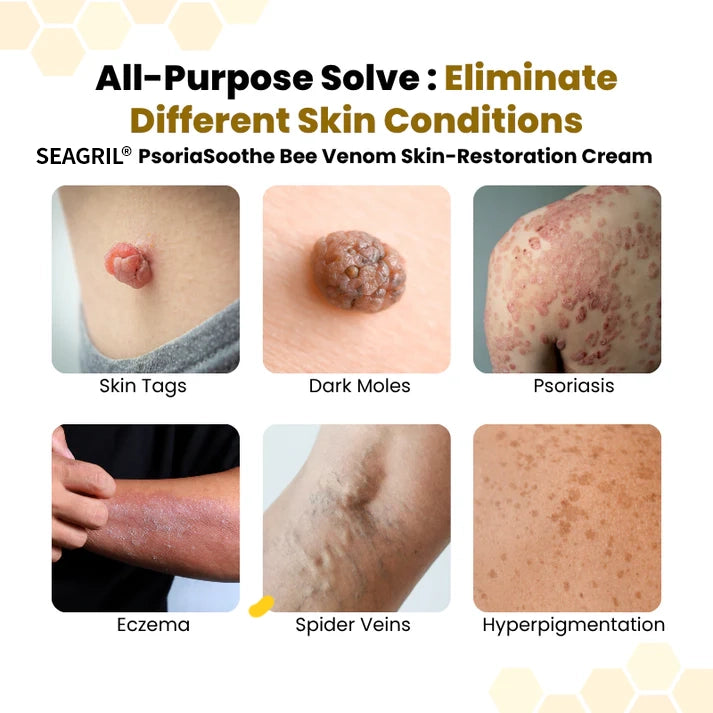 SEAGRIL® PsoriaSoothe Bee Venom Skin-Restoration Cream