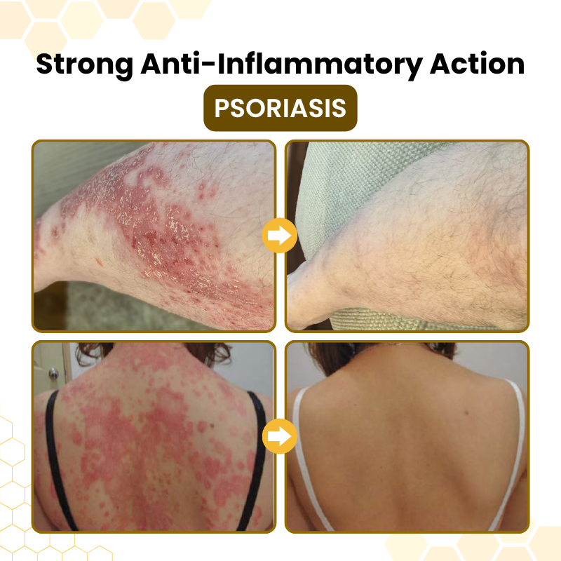 SEAGRIL® PsoriaSoothe Bee Venom Skin-Restoration Cream