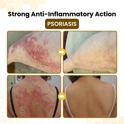 SEAGRIL® PsoriaSoothe Bee Venom Skin-Restoration Cream
